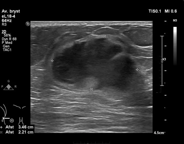 A patient, who was diagnosed with Small Cell Lung Cancer