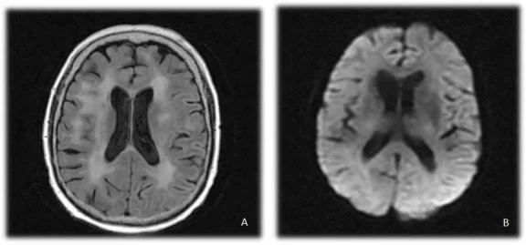 A patient, who was diagnosed with Small Cell Lung Cancer