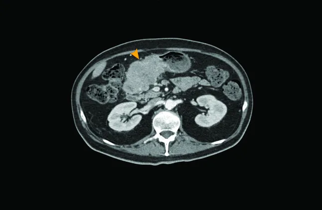A patient, who was diagnosed with Gastric Adenocarcinoma