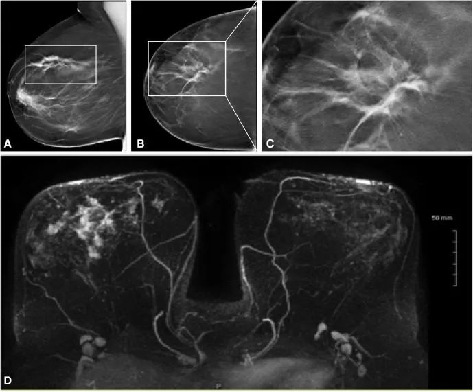 A patient, who was diagnosed with Invasive Lobular Carcinoma