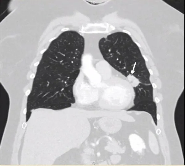 A patient, who was diagnosed with Non-Small Cell Lung Cancer