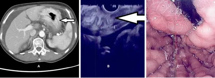 A patient, who was diagnosed with Invasive Lobular Carcinoma