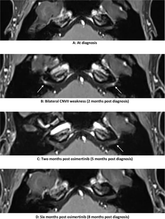 A patient, who was diagnosed with Stage IV Lung Adenocarcinoma