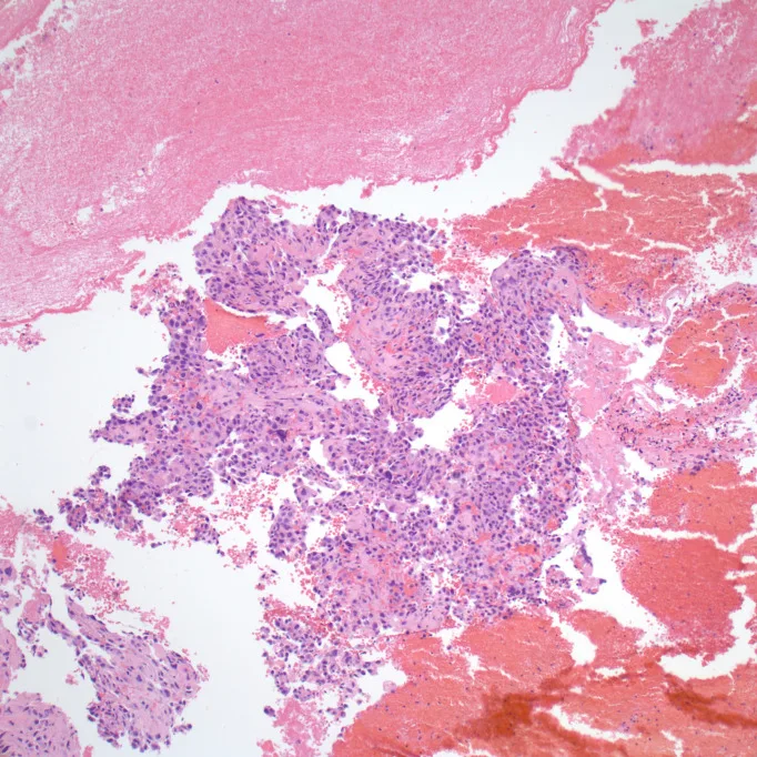 A patient, who was diagnosed with Stage I Lung Adenocarcinoma