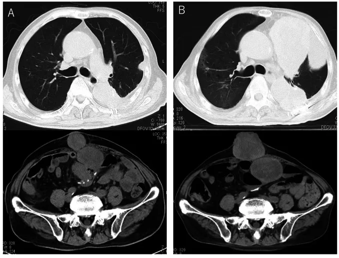 A patient, who was diagnosed with Stage III Lung Cancer