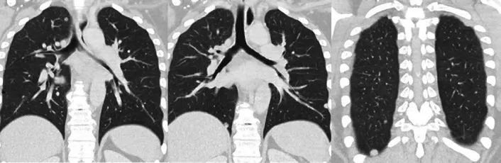 A patient, who was diagnosed with Ovarian Cancer