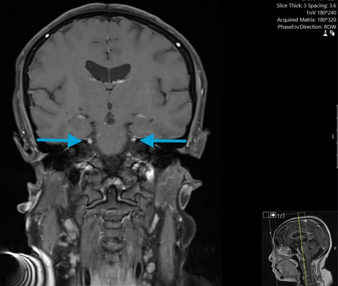 A patient, who was diagnosed with Stage IV Ovarian Cancer