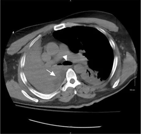 A patient, who was diagnosed with Stage II Non-Small Cell Lung Cancer