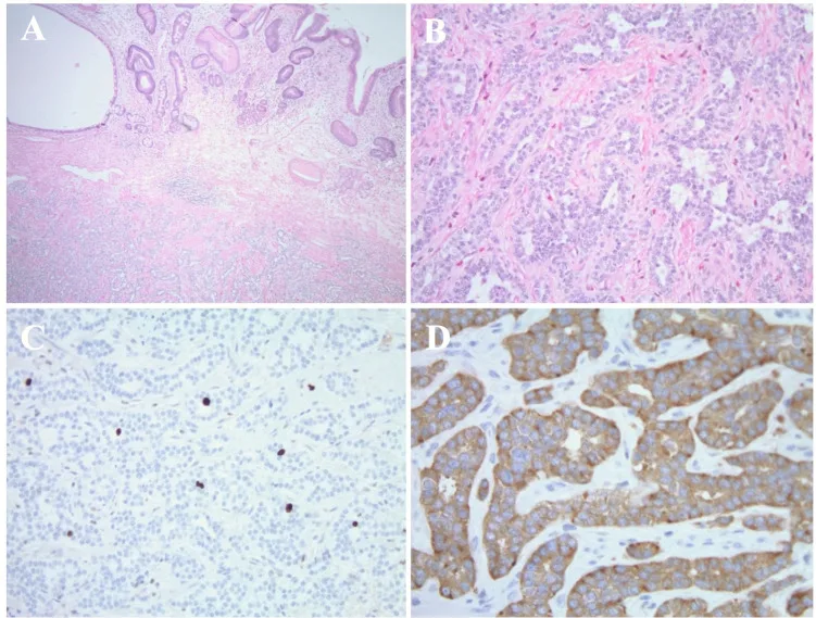 A patient, who was diagnosed with Gastric Cancer