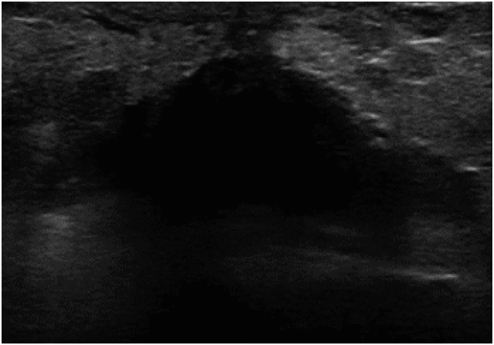 A patient, who was diagnosed with Invasive Lobular Carcinoma