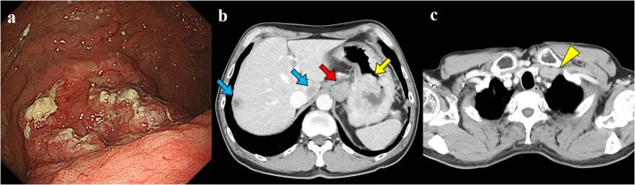 A patient, who was diagnosed with Gastric Adenocarcinoma