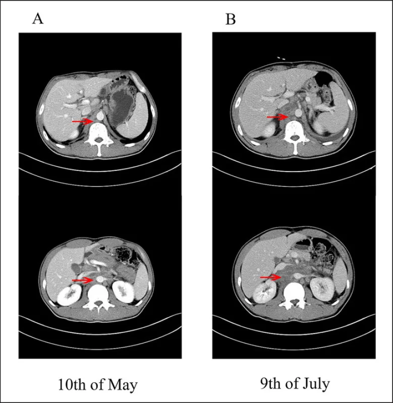 A patient, who was diagnosed with Stage III Colorectal Cancer