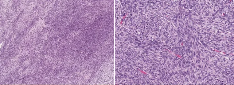 A patient, who was diagnosed with Ovarian Cancer