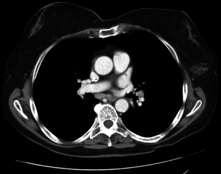 A patient, who was diagnosed with Ovarian Cancer