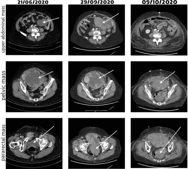 A patient, who was diagnosed with Ovarian Cancer