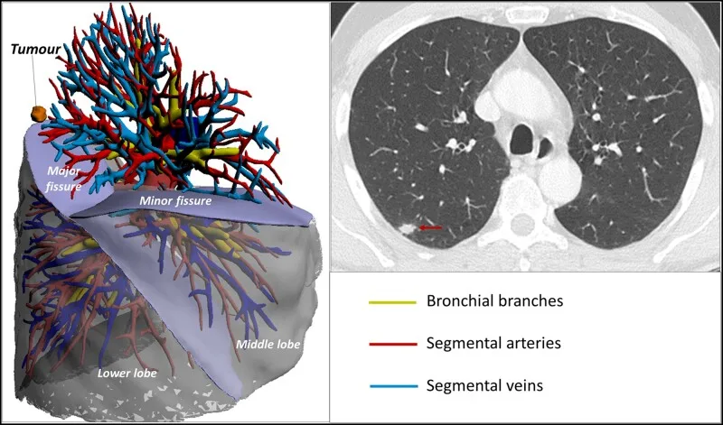 A patient, who was diagnosed with Lung Adenocarcinoma