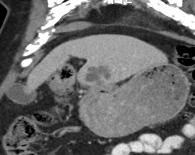 A patient, who was diagnosed with Gastric Adenocarcinoma