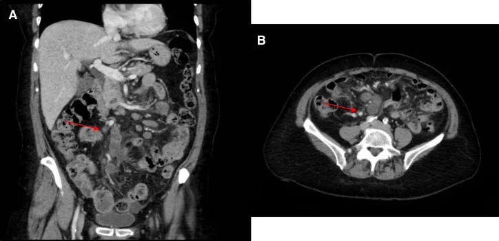 A patient, who was diagnosed with Stage IV Breast Cancer