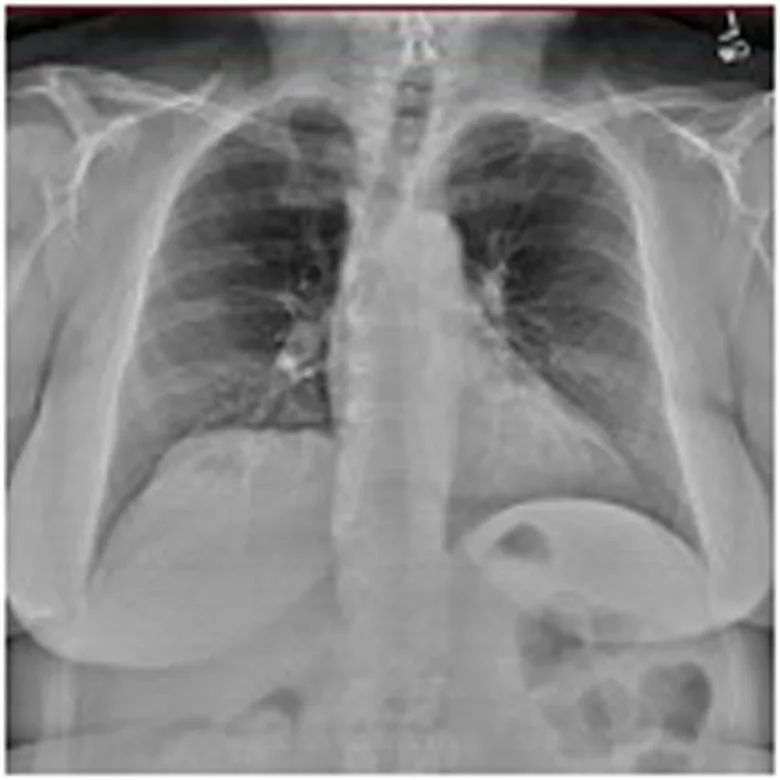A patient, who was diagnosed with Stage I Invasive Ductal Carcinoma