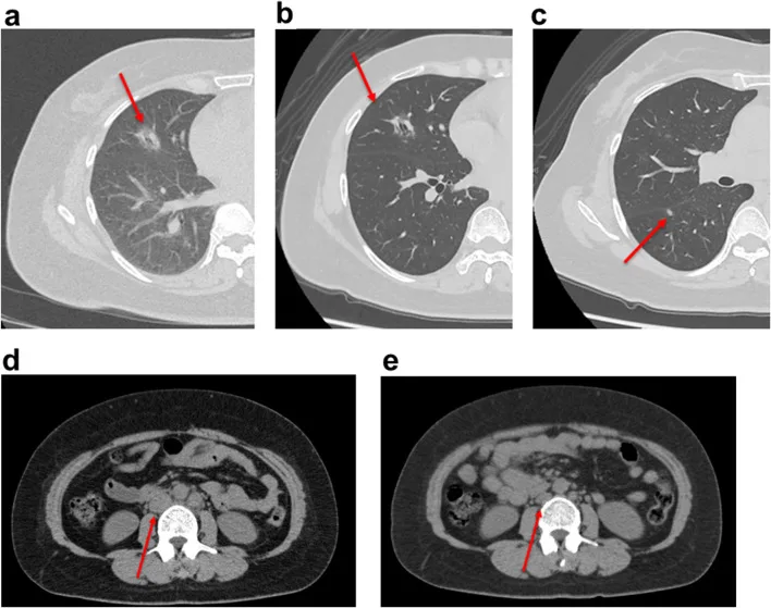 A patient, who was diagnosed with Lung Adenocarcinoma