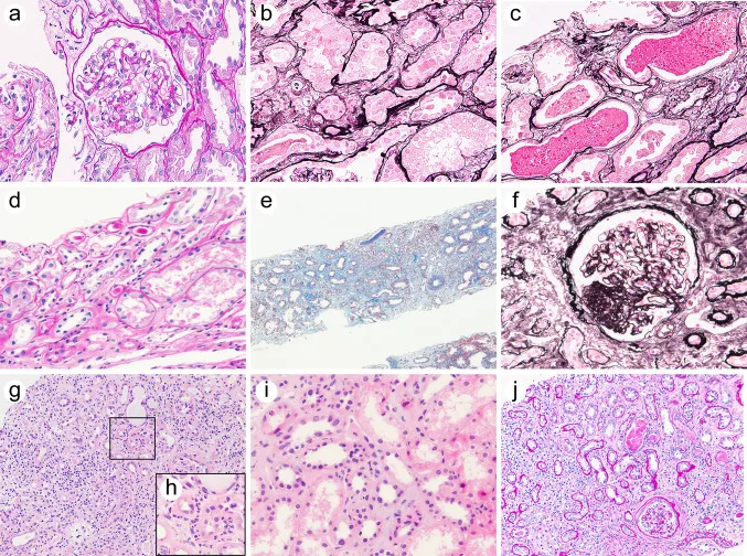 A patient, who was diagnosed with Lung Adenocarcinoma