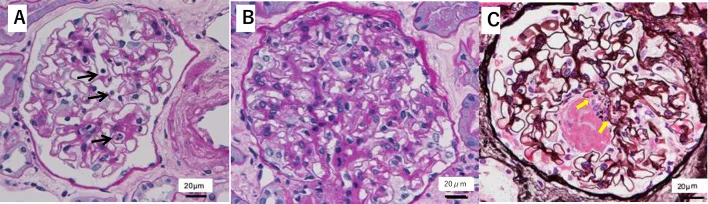 A patient, who was diagnosed with Stage IV Non-Small Cell Lung Cancer