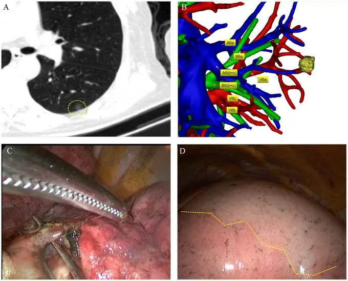 A patient, who was diagnosed with Lung Adenocarcinoma