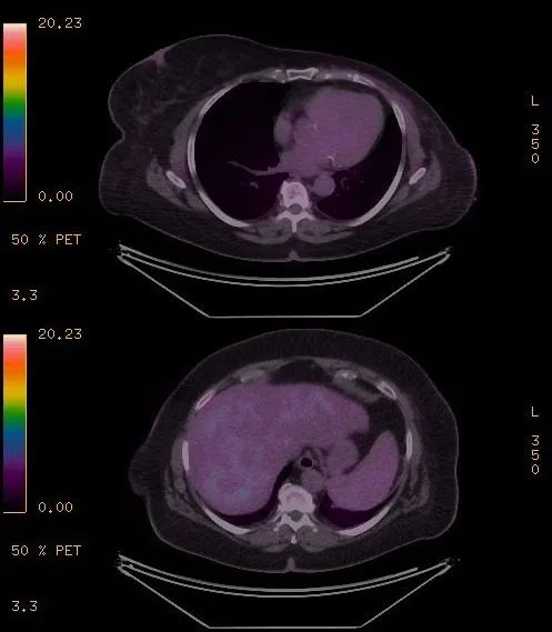 A patient, who was diagnosed with Stage IV Invasive Lobular Carcinoma