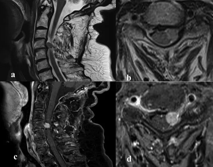 A patient, who was diagnosed with Ovarian Adenocarcinoma