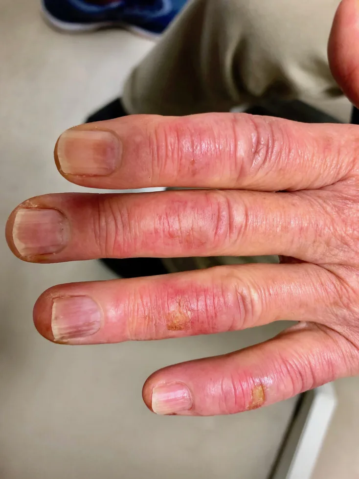 A patient, who was diagnosed with Ovarian Adenocarcinoma