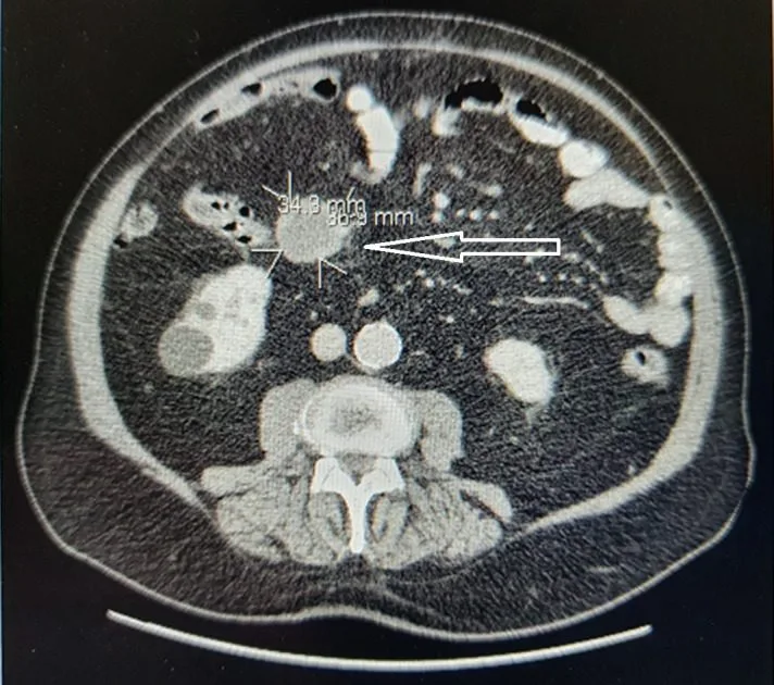 A patient, who was diagnosed with Colorectal Adenocarcinoma
