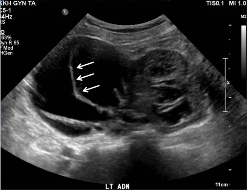 A patient, who was diagnosed with Ovarian Cancer