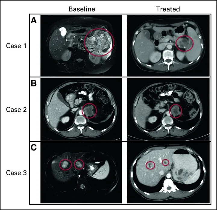 A patient, who was diagnosed with Stage IV Colorectal Adenocarcinoma