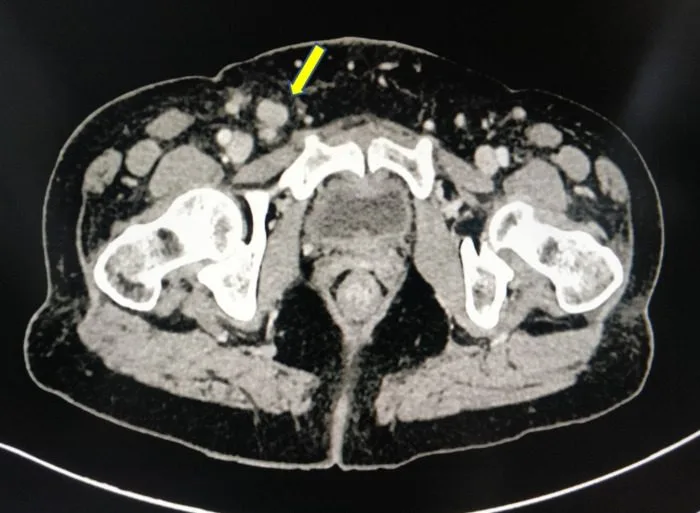 A patient, who was diagnosed with Stage IV Invasive Ductal Carcinoma