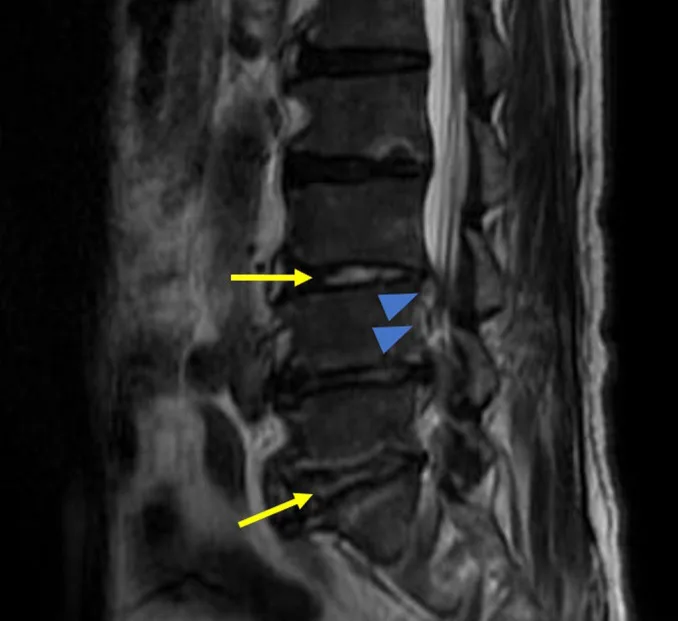 A patient, who was diagnosed with Stage I Gastric Adenocarcinoma