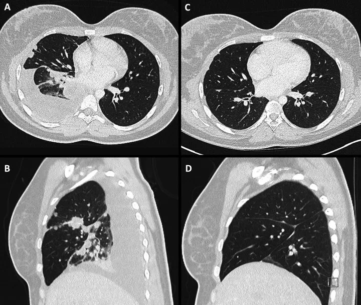 A patient, who was diagnosed with Stage IV Non-Small Cell Lung Cancer