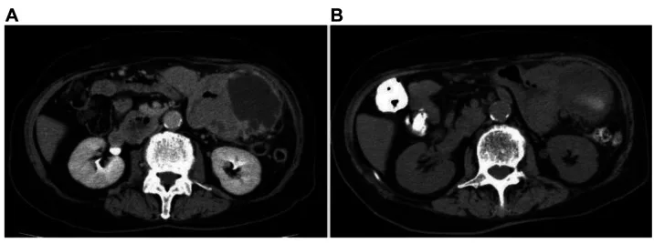 A patient, who was diagnosed with Stage II Gastric Adenocarcinoma
