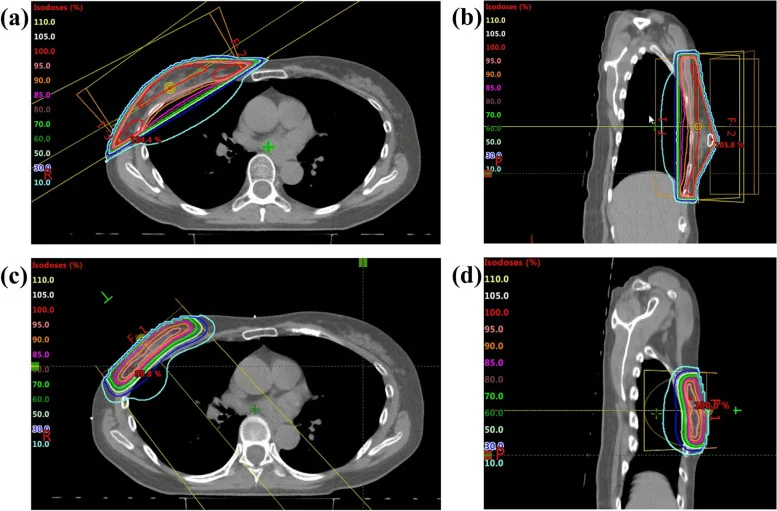 A patient, who was diagnosed with Invasive Ductal Carcinoma