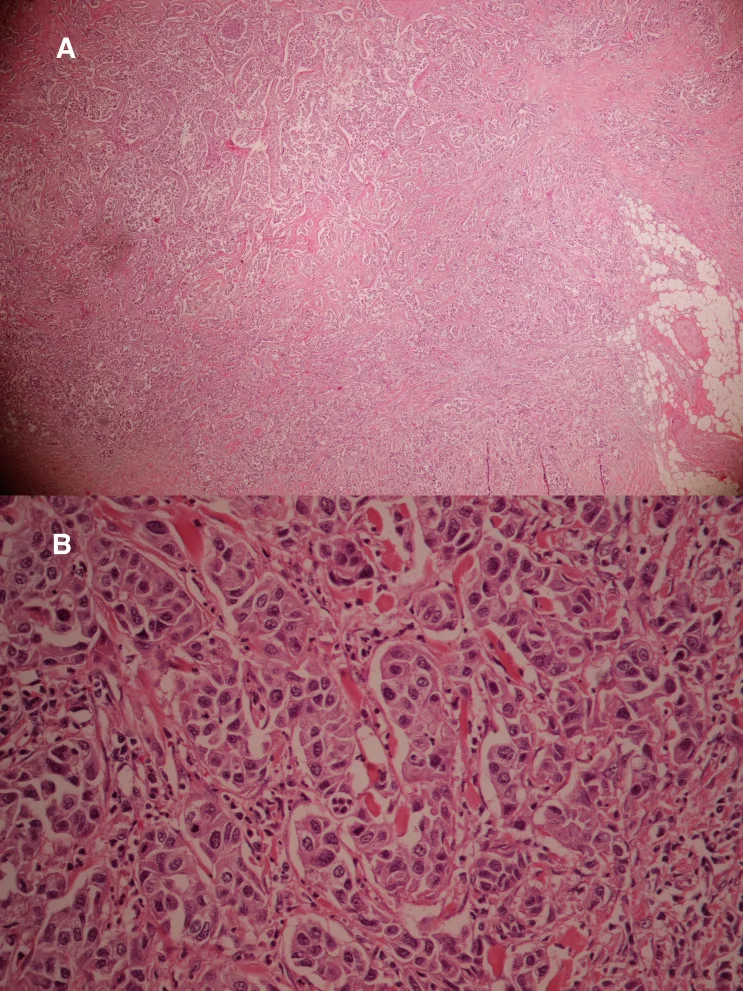 A patient, who was diagnosed with Invasive Ductal Carcinoma