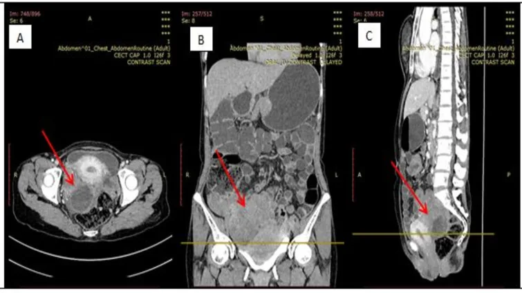 A patient, who was diagnosed with Stage III Ovarian Cancer