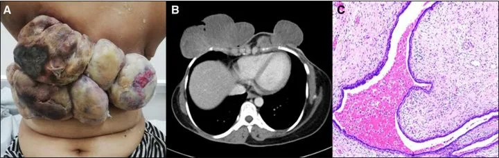A patient, who was diagnosed with Breast Cancer