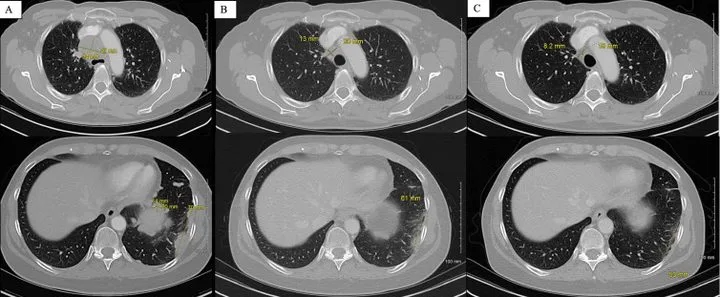 A patient, who was diagnosed with Stage IV Invasive Ductal Carcinoma