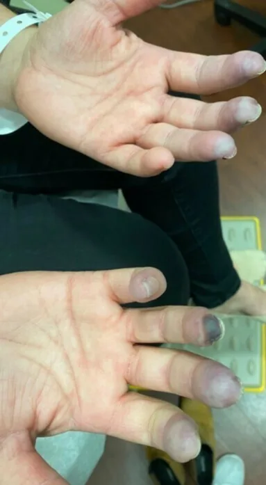 A patient, who was diagnosed with Stage IV Invasive Ductal Carcinoma