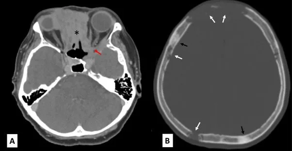 A patient, who was diagnosed with Stage IV Invasive Ductal Carcinoma