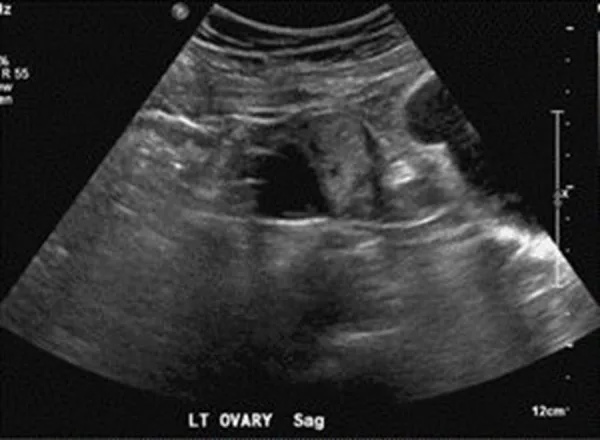 A patient, who was diagnosed with Ovarian Cancer