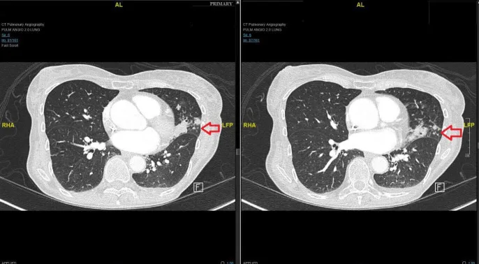 A patient, who was diagnosed with Stage III Ovarian Cancer