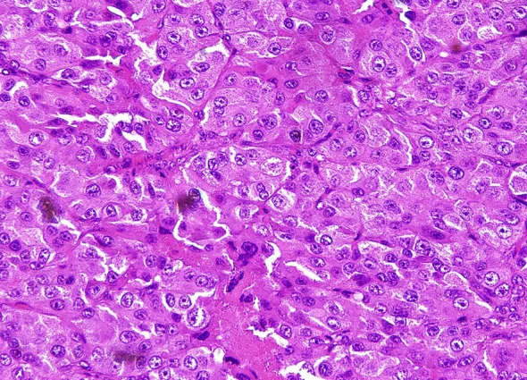 A patient, who was diagnosed with Ovarian Cancer