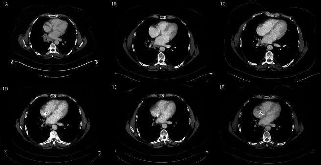 A patient, who was diagnosed with Stage IV Non-Small Cell Lung Cancer