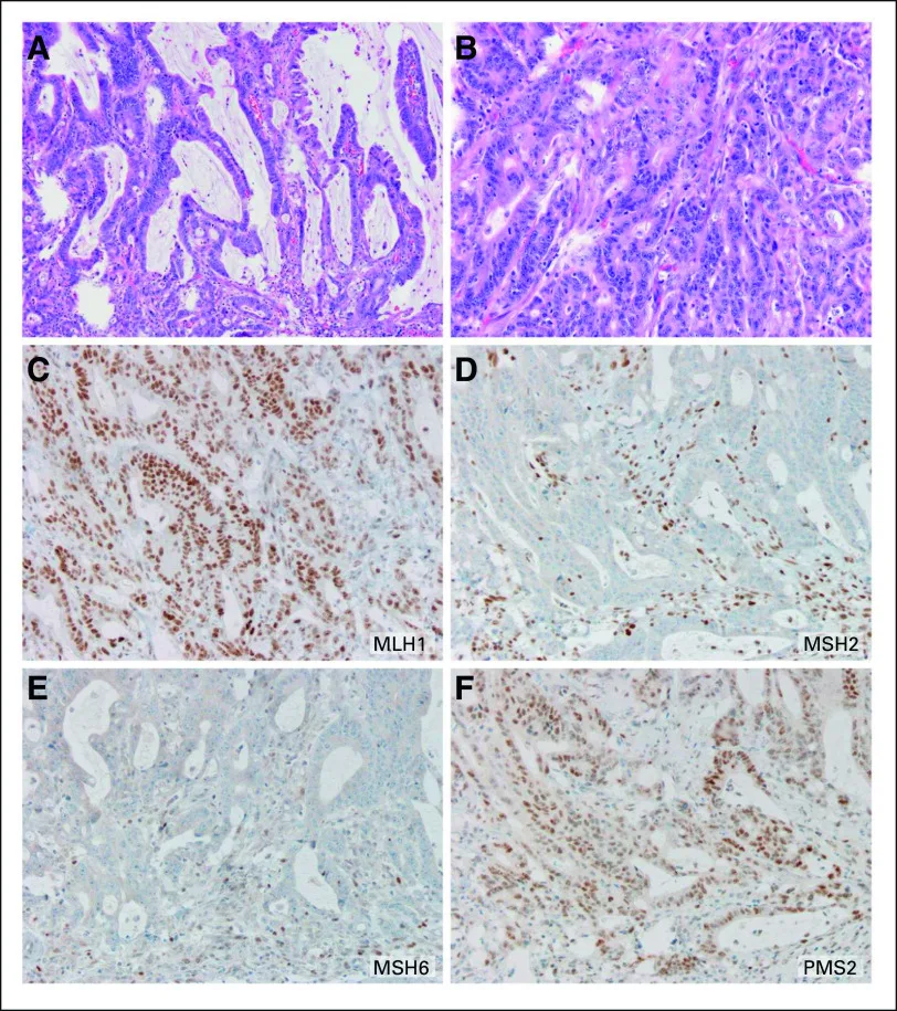 A patient, who was diagnosed with Colorectal Adenocarcinoma