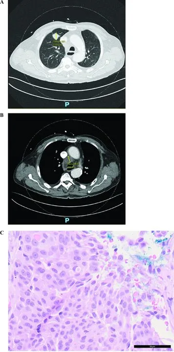 A patient, who was diagnosed with Lung Adenocarcinoma